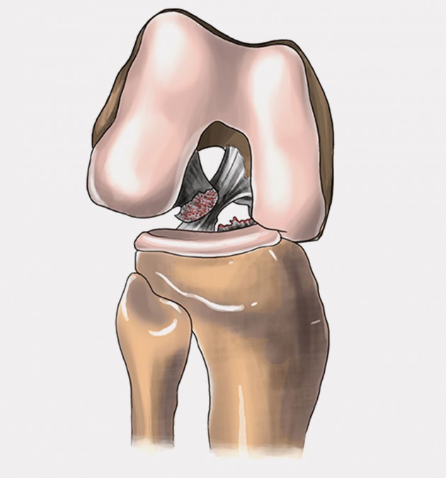 Awulsja AWULSJA - oderwanie więzadła z fragmentem kostnym