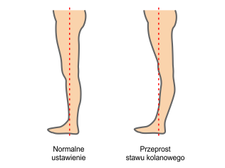 Przeprost stawu kolanowego