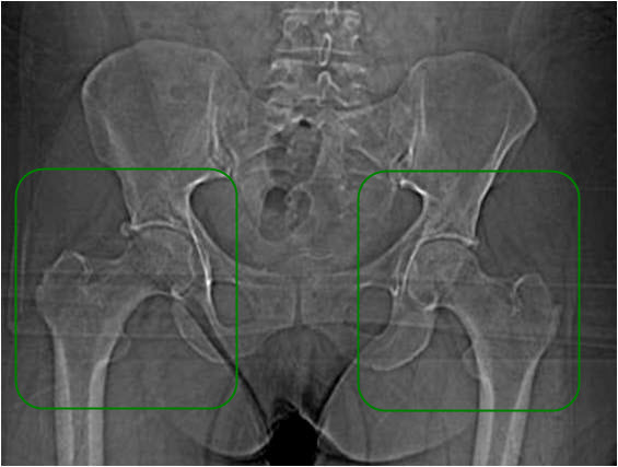 Zdrowe stawy biodrowe starszej kobiety.